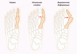 Jak odstranit kost v noze